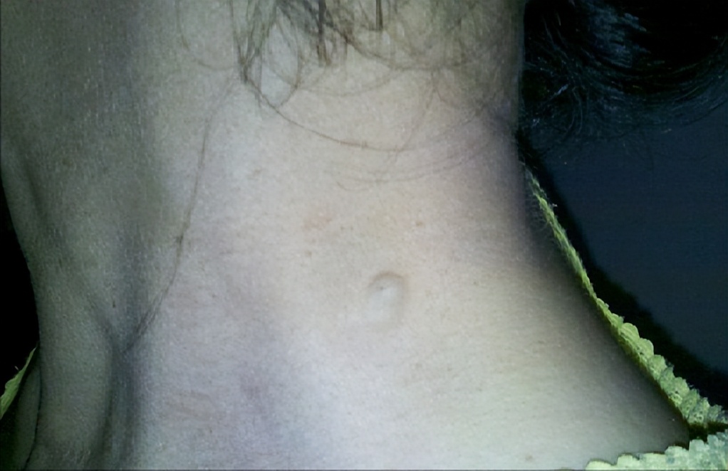 脖子上小肉粒可以揪下来,脖子上长的小肉粒自己揪掉可以吗