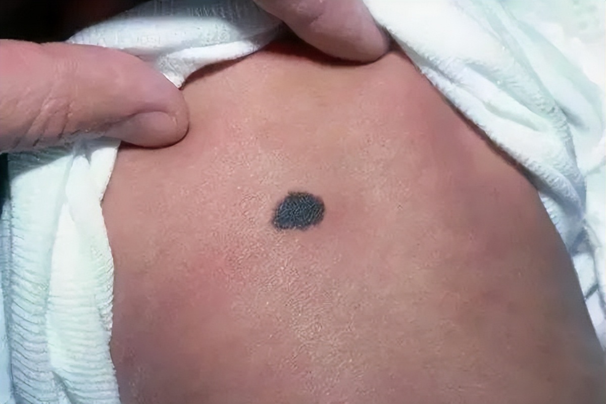 医生如何检查黑痣和黑色素瘤,医生长在摩擦部位的黑痣要当心