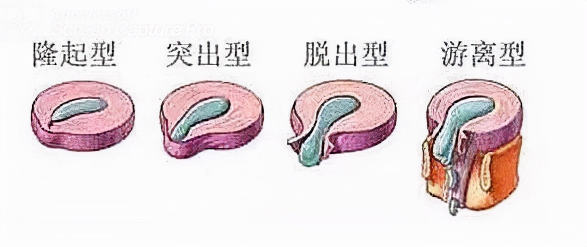 腰椎间盘突出10mm还能保守治疗吗,腰椎间盘突出可以保守治疗痊愈吗