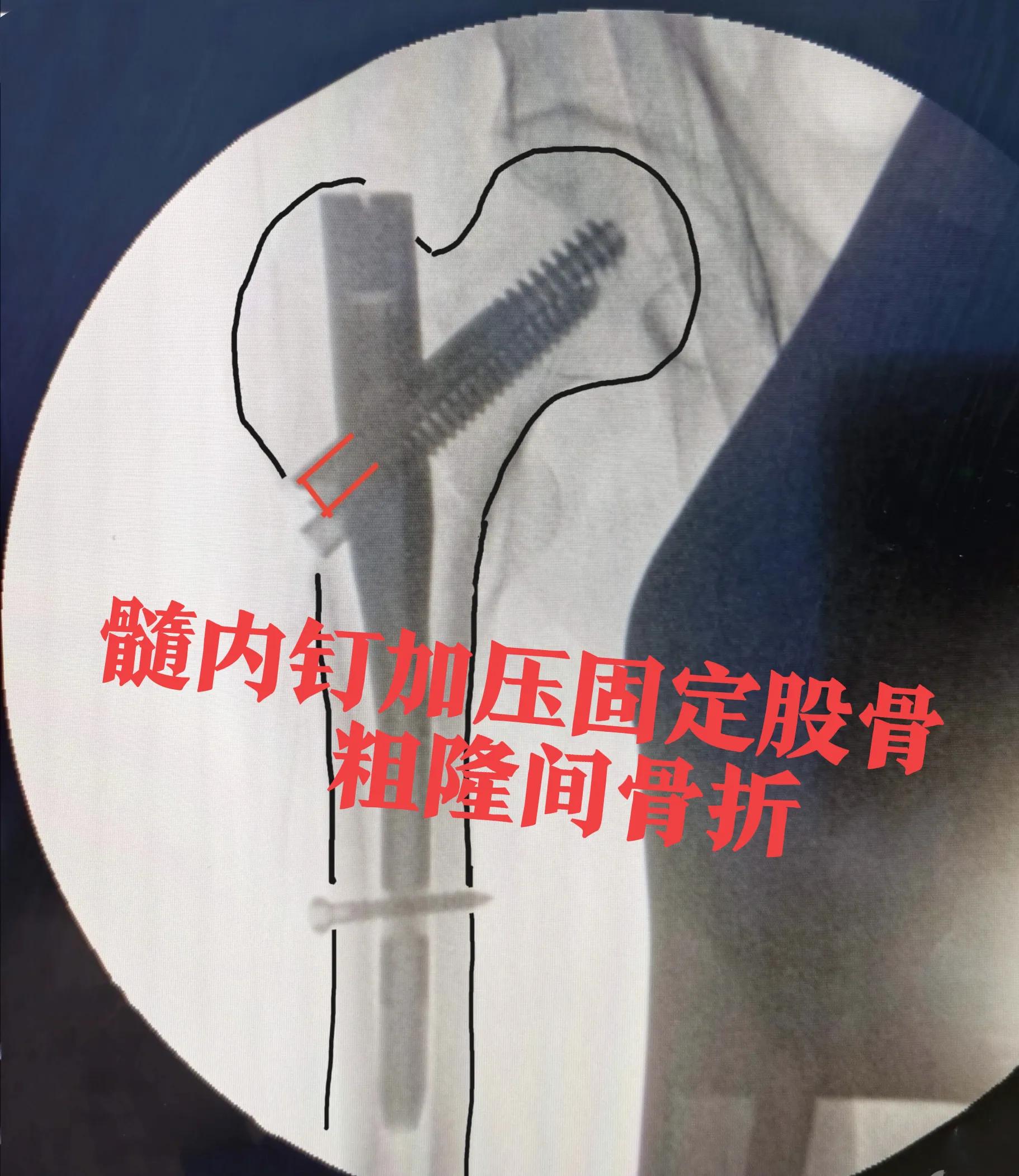 股骨粗隆间骨折内钉技巧图解,股骨粗隆骨折髓内钉操作视频