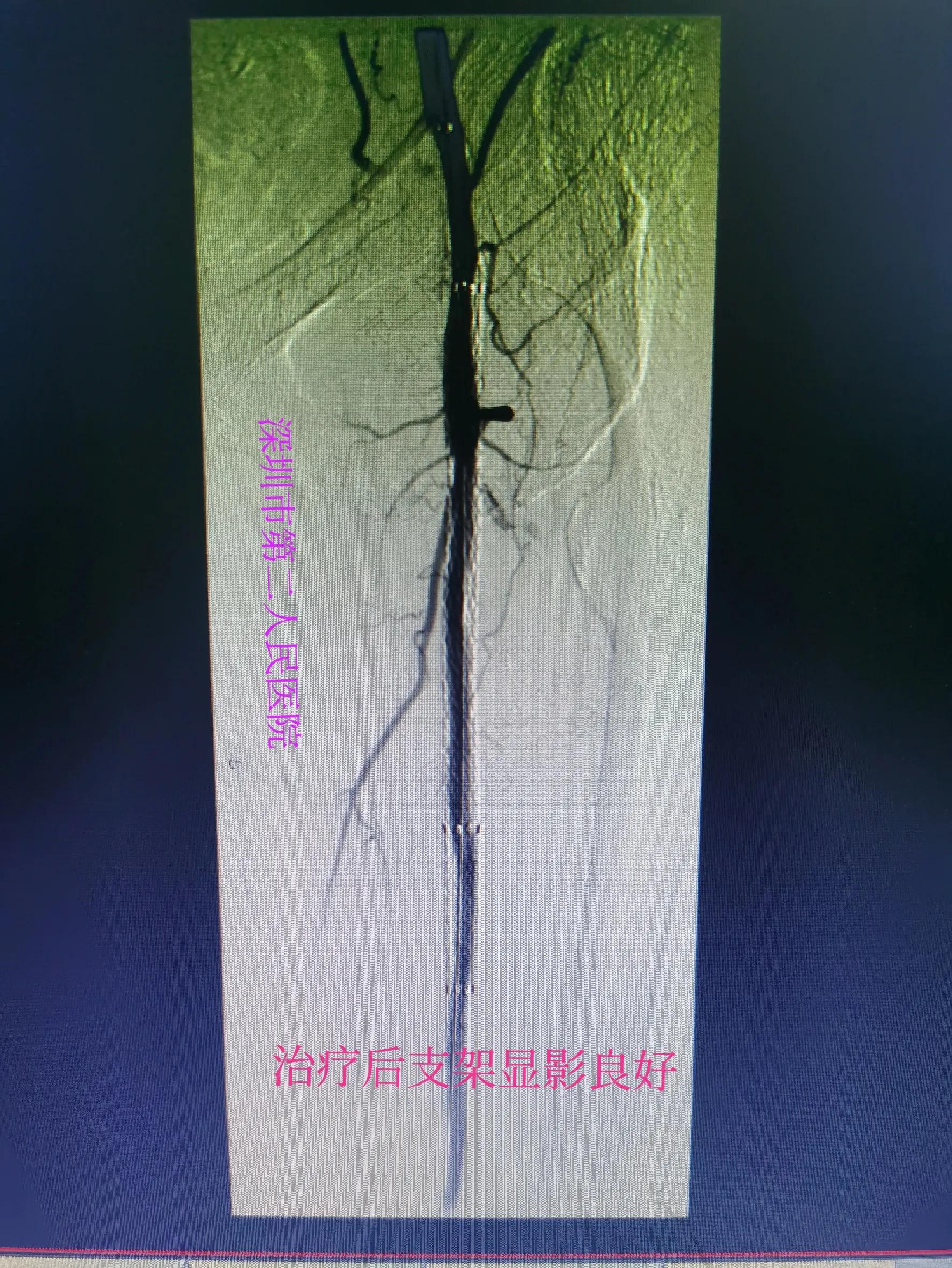 老年人小腿浮肿发紫什么原因,老人突然小腿发凉发软