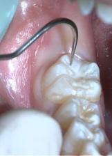 几岁到几岁适合做窝沟封闭,长大了还可以做窝沟封闭吗