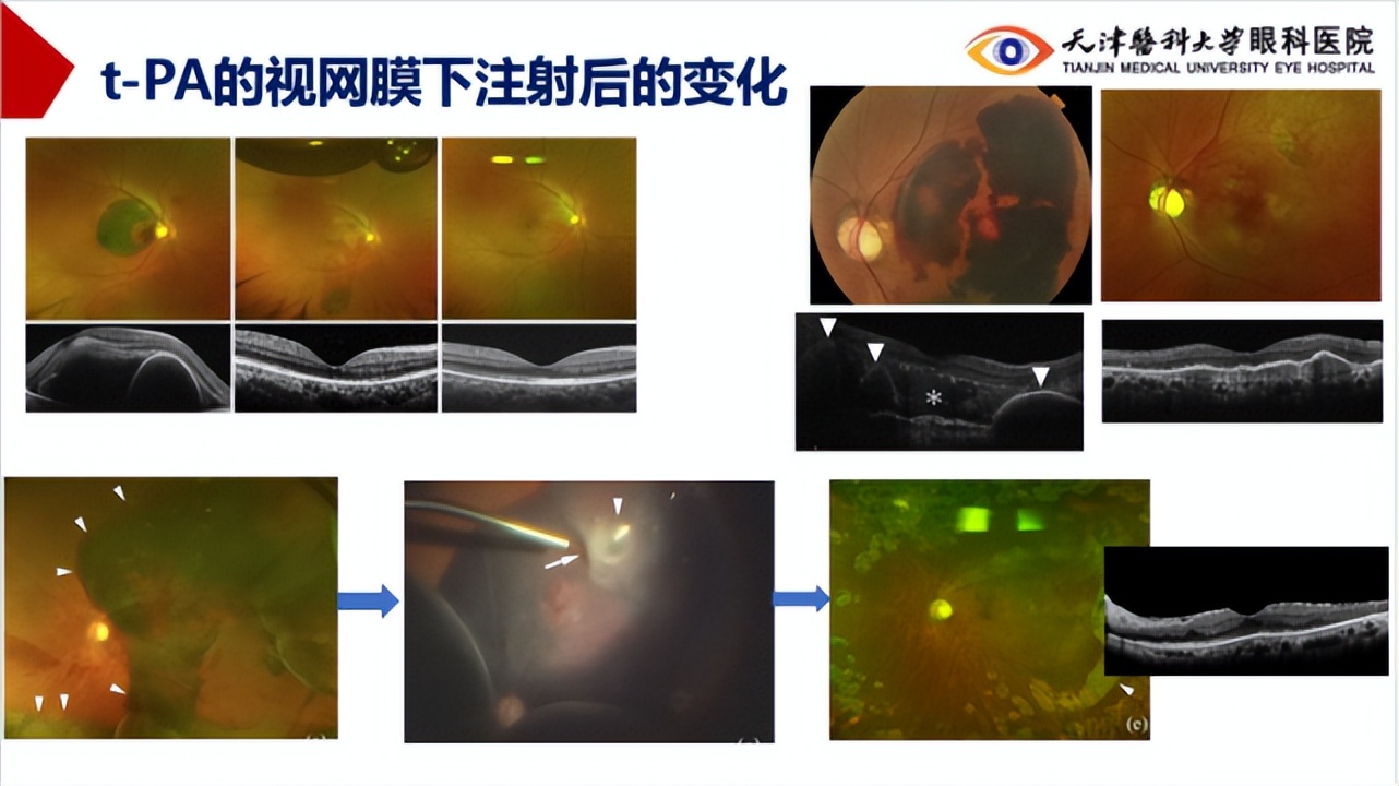 李筱荣教授,天津医科大学眼科医院李筱荣