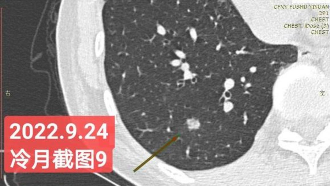 7mm肺结节恶性的怎么办,7mm实性肺结节危险程度