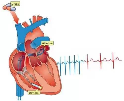 心慌心动过速房颤健康科普,气温骤降警惕呼吸系统疾病