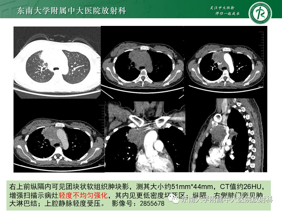 好文分享值得深思,纵隔精原细胞瘤