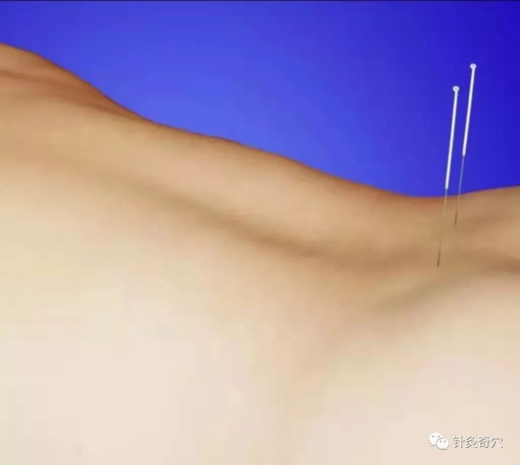 史上最全中医针灸视频教程全集,针灸治疗真实图片大全