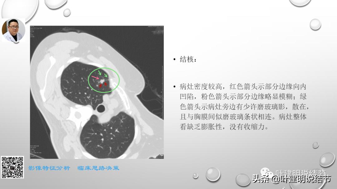在《一脉阳光》呼吸影像诊断专题培训班上的讲课PPT（第一部分）