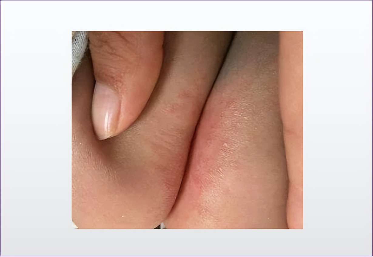 宝宝嘴唇干裂起红屁股怎么治,红脸蛋宝宝用什么面霜