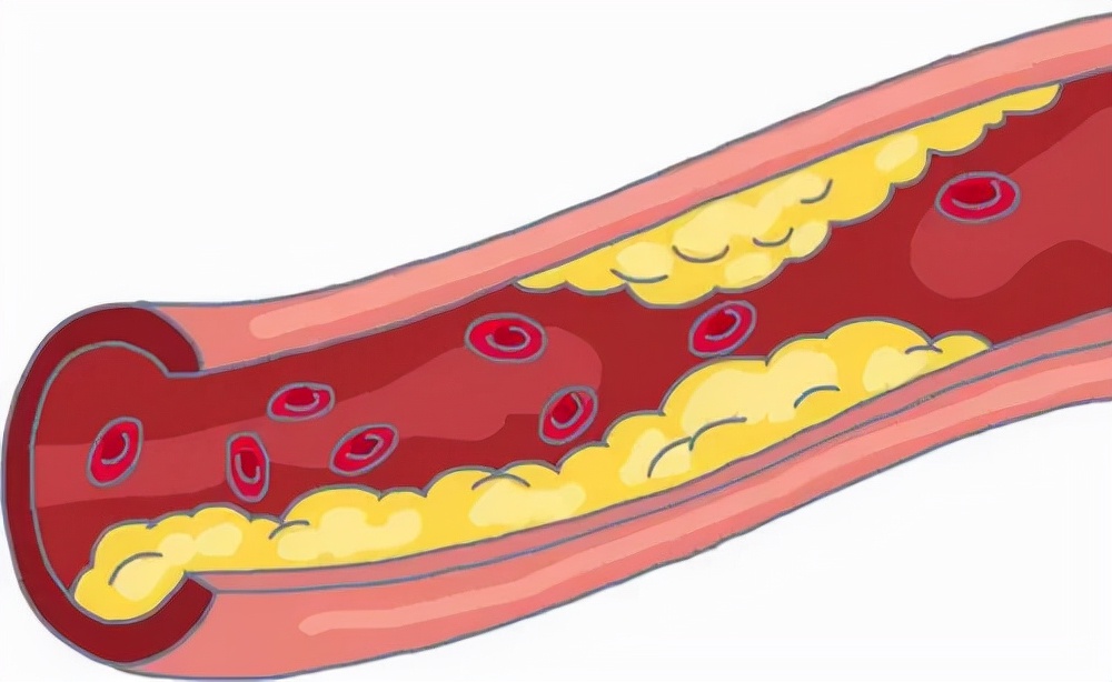 发现动脉硬化还能活多久,发现血管斑块是不是就是脑梗了