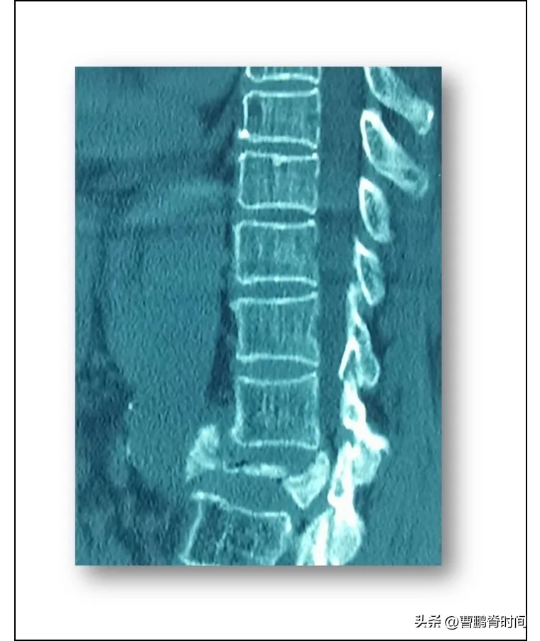 跳绳导致胸椎压缩性骨折,跳绳跳到肋骨脱臼