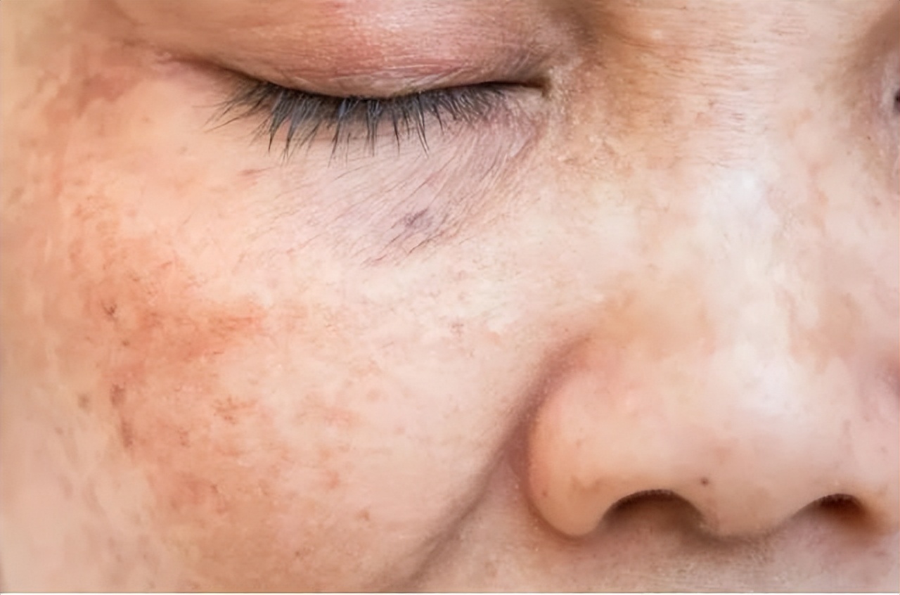 老年斑越来越多教你个好办法,为啥有的老年人老年斑越长越多