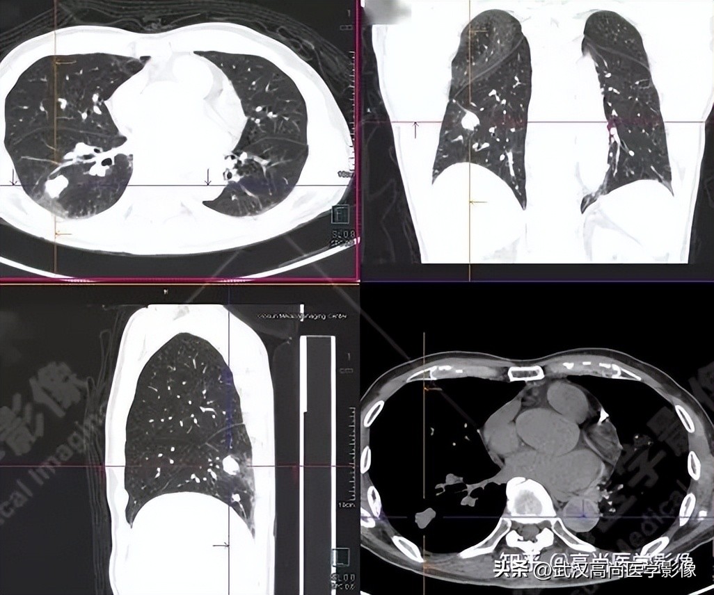 10毫米的肺结节恶性死亡率有多大,1厘米多的肺结节良性可能性多大