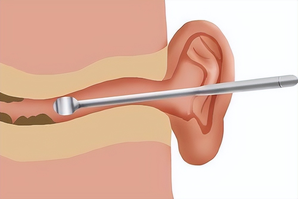 耳朵痒一掏就流水有臭味用什么药,耳朵老是痒天天都要掏怎么回事