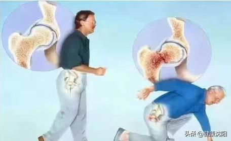 老年人怎么会引起股骨颈骨折,高龄老人股骨颈骨折怎么办恢复快