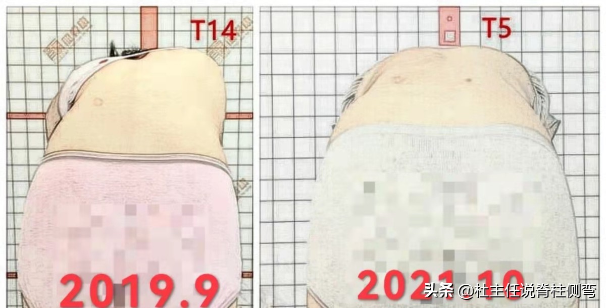 40多岁脊柱侧弯能戴矫正器吗,s弯脊柱侧弯40度要手术吗