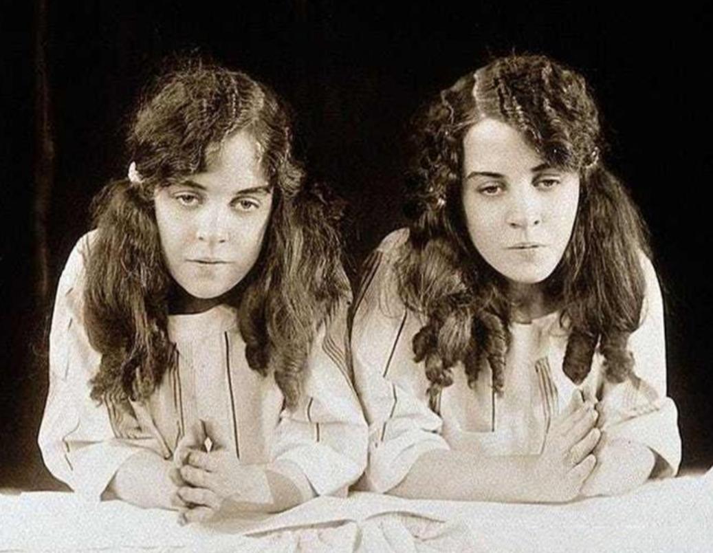 英国连体双胞胎姐妹,英国连体姐妹