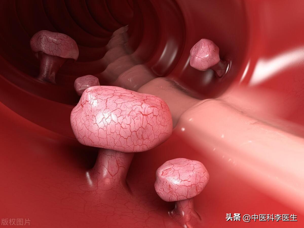 为什么这么多人最怕做肠镜,院士说肠镜一次可以保几年