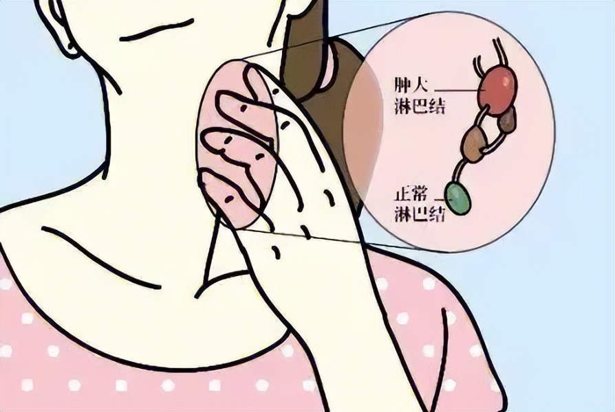 女性患者59岁发现颈部包块,脖子淋巴结有个疙瘩是肺癌转移吗