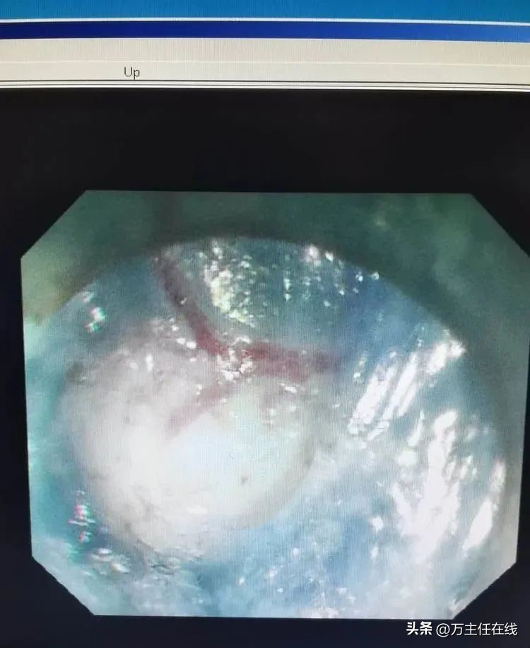 上海第一人民医院消化科万荣教授,消化内科专家手术