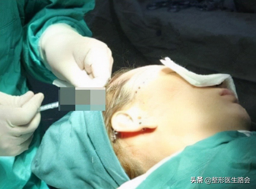自体脂肪丰额头的危险,自体脂肪和膨体