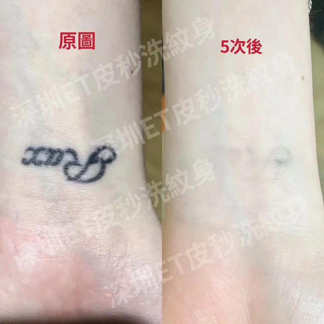 深圳清洗纹身哪家专业,推荐深圳专业洗纹身