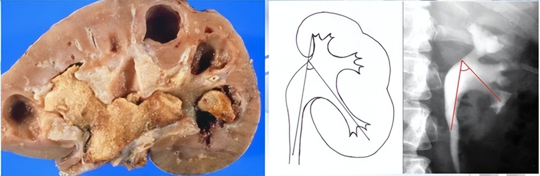明知山有虎,偏向虎山行——肾斗士VS肾结石