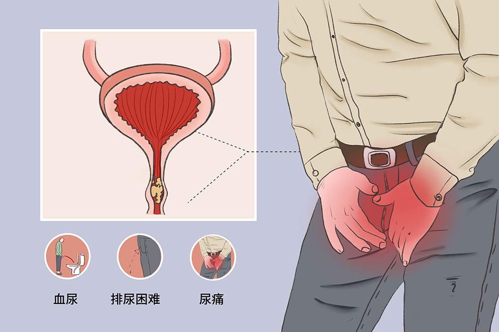 龙胆泻肝丸尿结石,中医有没有好方子调理尿结石