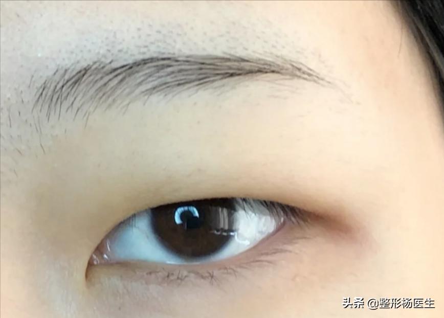 肿眼泡适合做埋线双眼皮吗,贴双眼皮贴还是肿眼泡可以埋线吗