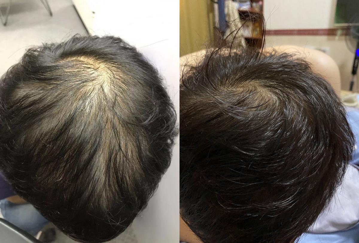 25岁头顶脱发,15岁治疗脱发头顶稀疏的方法