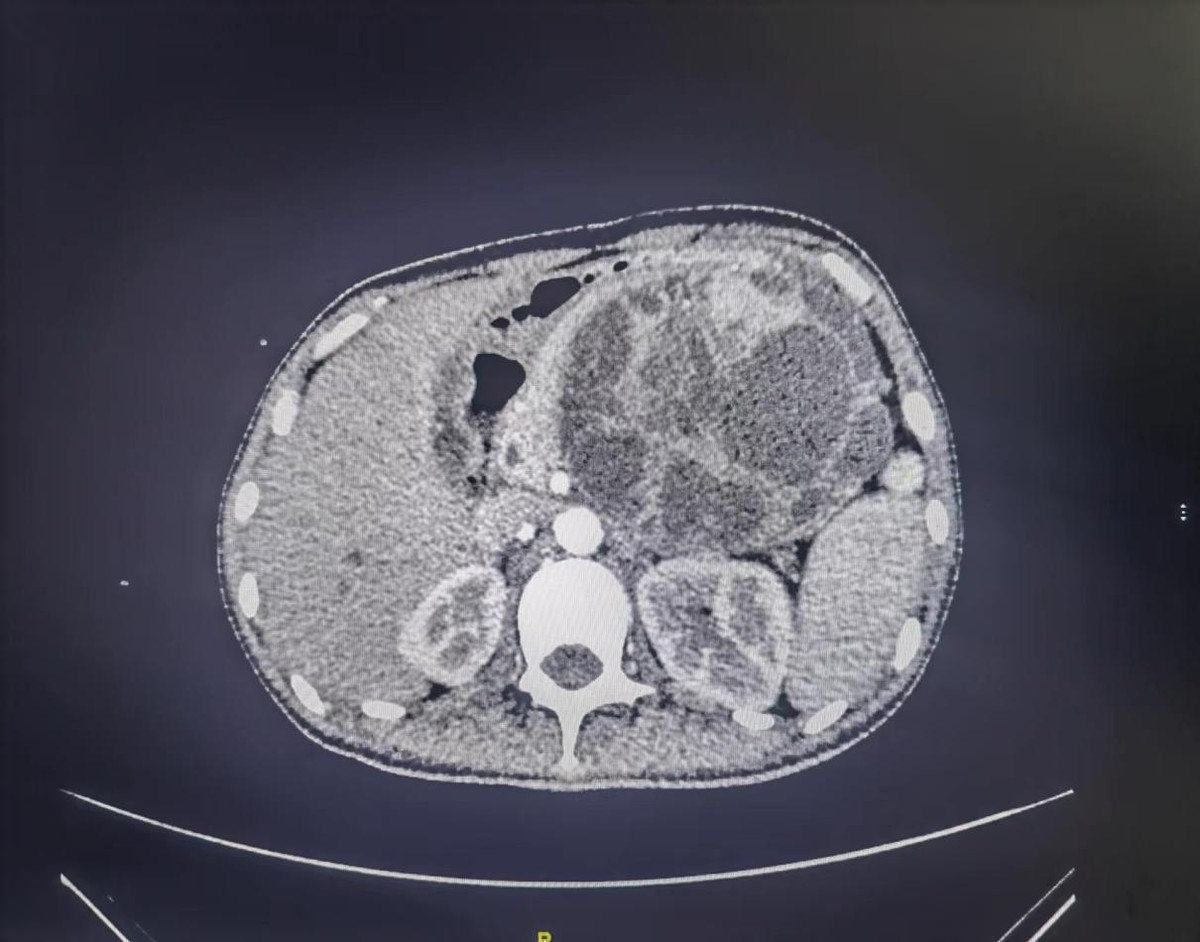 哈医大一院微创胆道外科怎么样,哈医大一院胰腺外科