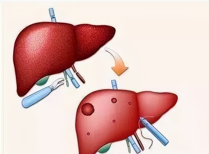 丙肝2a亚型用吉二代能治好吗,丙肝能治好吗治愈后能再复发吗
