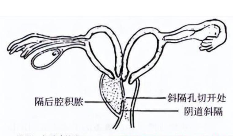 女子检查妇科发现体内有三个病,24岁女子体检发现有两个子宫