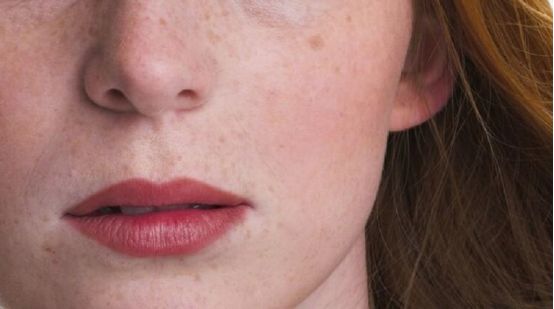 脸上长了色斑怎么办,脸上长色斑缺什么维生素