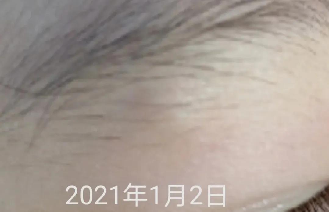 皮脂腺囊肿挤出囊袋,皮脂腺囊肿切除手术