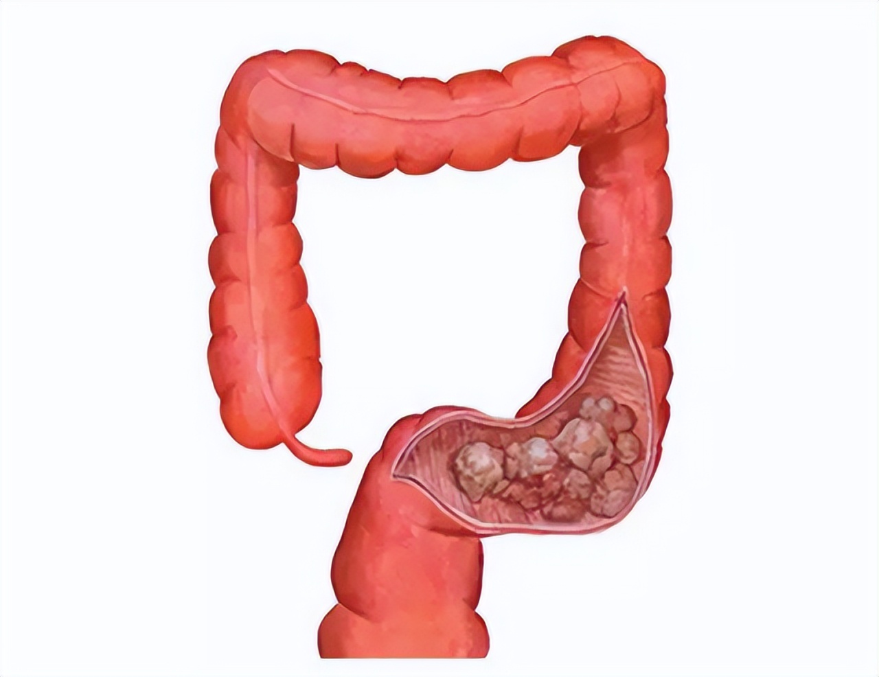 总感觉大便拉不干净，这是怎么回事？医生提醒：留意这3种病