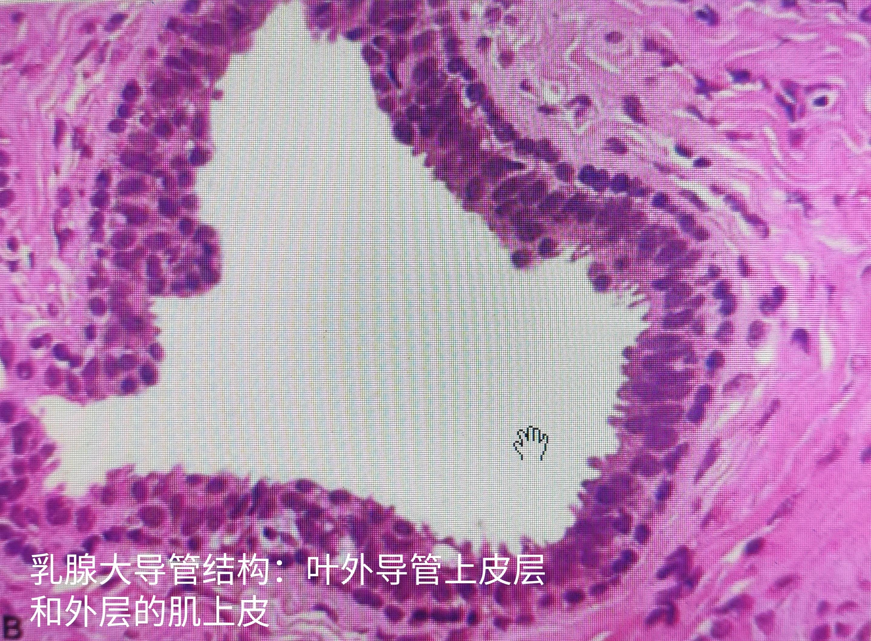 除了乳腺癌胸部还可能会得什么病,乳腺导管内病变不除外4a严重吗
