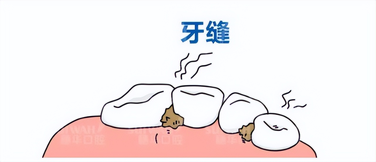 吃东西老是塞牙缝怎么解决,吃东西经常塞牙齿