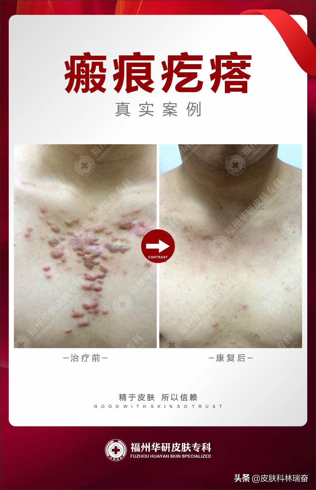 以前没有疤痕会长疤痕疙瘩么,快一年的疤痕疙瘩怎么治疗