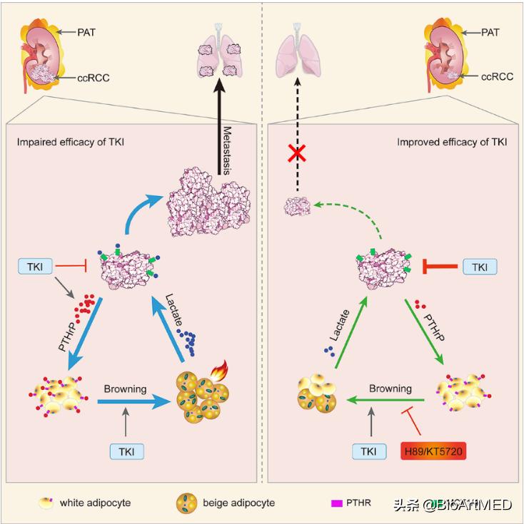 刘军力/王林辉团队发现肾周脂肪棕色化促癌新机制