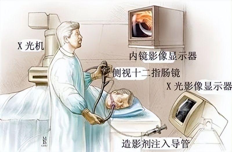 科普不可忽视的胆囊结石,胆管结石科普视频