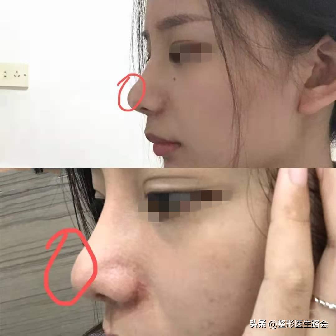 硅胶隆鼻和耳软骨隆鼻效果图,硅胶耳软骨隆鼻副作用