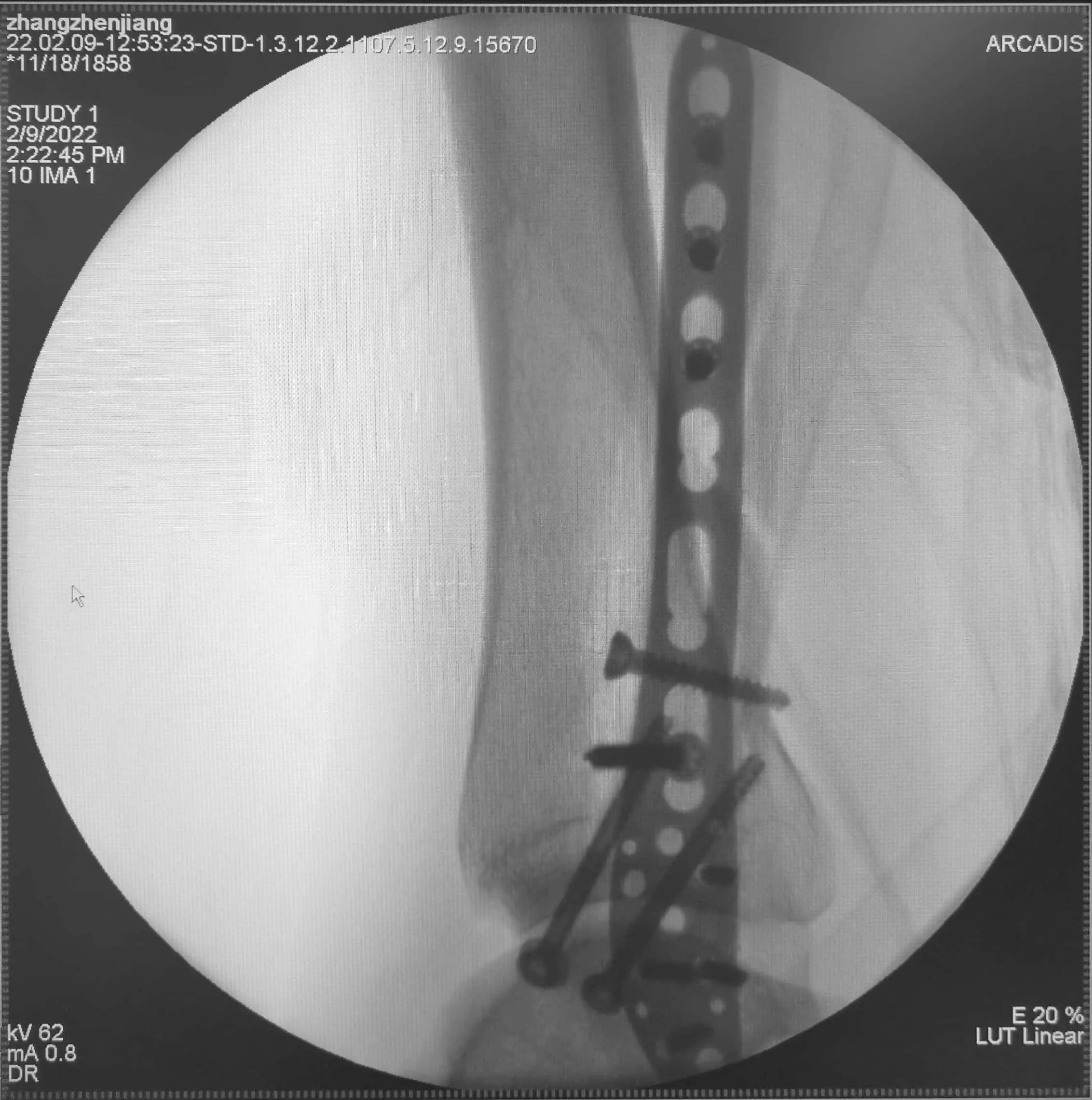 咋就不能先复一下位呢？手法复位就那么难吗？