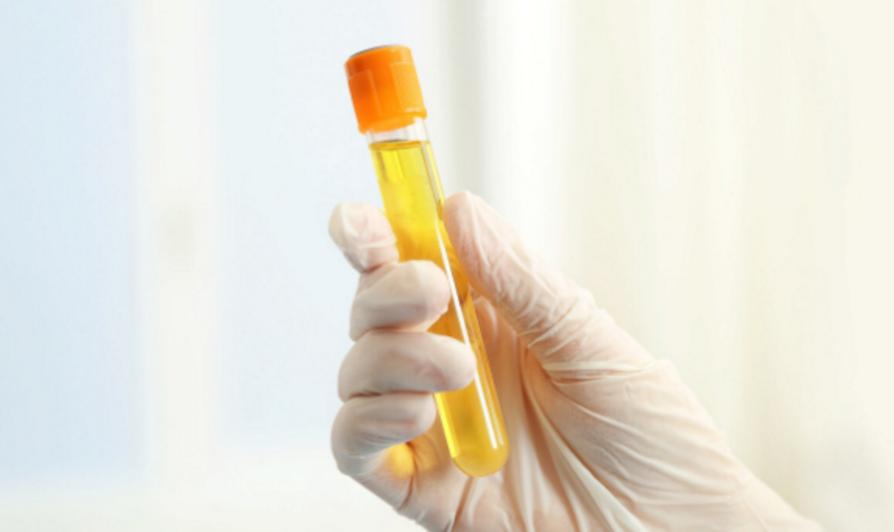 男性尿液有泡沫就是肾出了问题吗,小便有细小泡沫肾没问题怎么回事