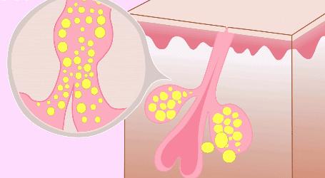 痘痘反反复复怎么办,脸上的痘痘反反复复