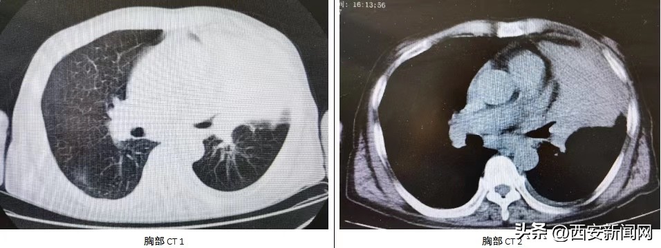 医院开展支气管镜下治疗,医院开展输尿管镜下钬激光碎石术