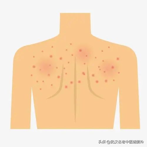 后背上有特别多的红色小痘痘,胸跟后背同时出现红色痘痘