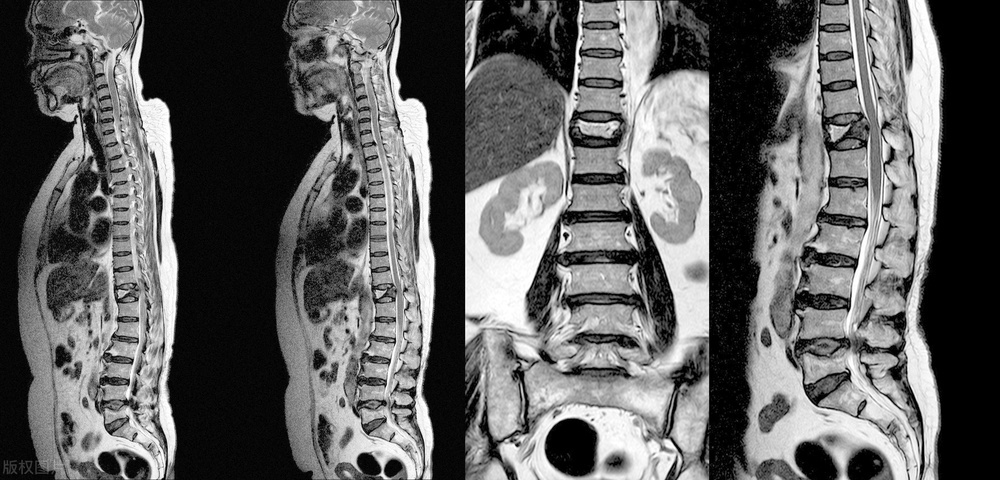 检查显示整个腰椎都膨出怎么办,查出腰椎间盘突出没有症状