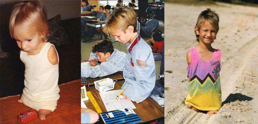 一出生就没有了四肢,一出生就失去一条腿