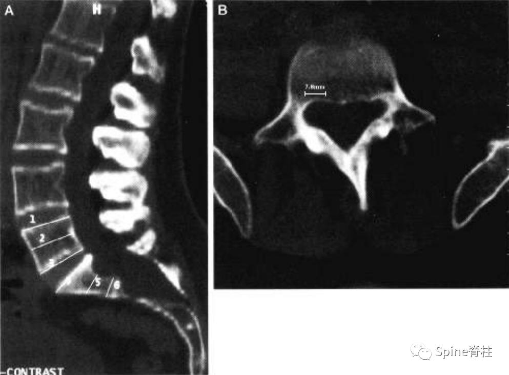 硬膜扩张,duralectasia